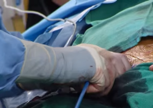 TAVI procedure